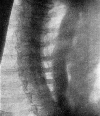 Fig. 285.—Radiogram, after swallowing an opaque meal,
in a man suffering from malignant stricture of lower end of Gullet.