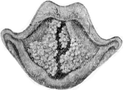 Fig. 288.—Papilloma of Larynx.