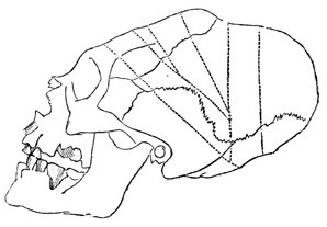Drawing showing angle of bandages to shape head