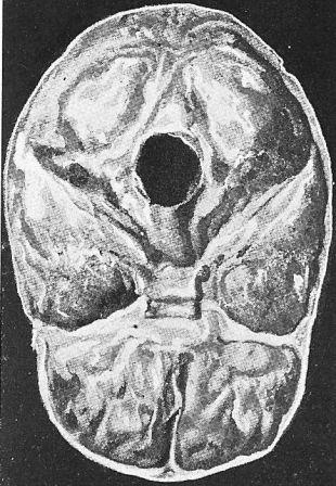 Fossette Occipital
