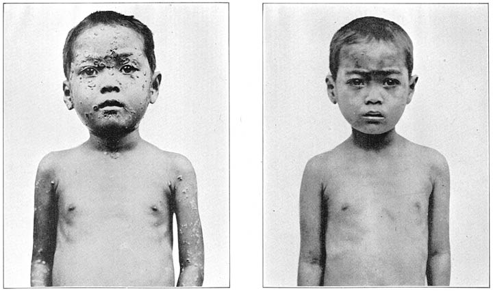 A Victim of Yaws before and after Treatment with Salvarsan