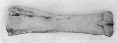 Fig. 16—Posterior view of radius (right) illustrative of
effects of splint. Note the extent of exostosis.