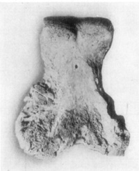 Fig. 30—Rarefying osteitis wherein articular cartilage
was destroyed in a case of arthritis of fetlock joint.