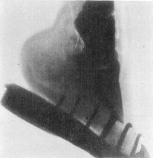 Fig. 39—Skiagraph of foot. The X-ray offers very limited
possibilities in the diagnosis of lameness. The location of a ''gravel''
or a nail that had worked its way some distance from the surface, or of
an abscess of some proportion, deep in the tissues, might be facilitated
under some circumstances by the aid of the X-ray. Its use in the
detention of fractures is very limited, owing to the difficulty
encountered in getting a view from the right position—many trials being
necessary in most cases. The case shown above was diagnosed clinically
as incipient ringbone. The X-ray revealed no lesions. (Photo by L.
Griessmann.)