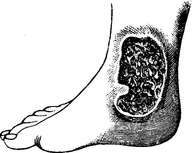 Illustration:
Fig. 2. A Chronic Ulcer.