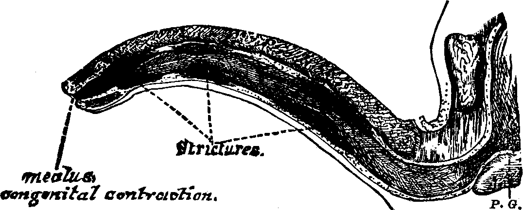 Illustration:
Fig. 3. Condition of the Urethra with three Strictures and a congenital
contraction at the meatus or outlet.