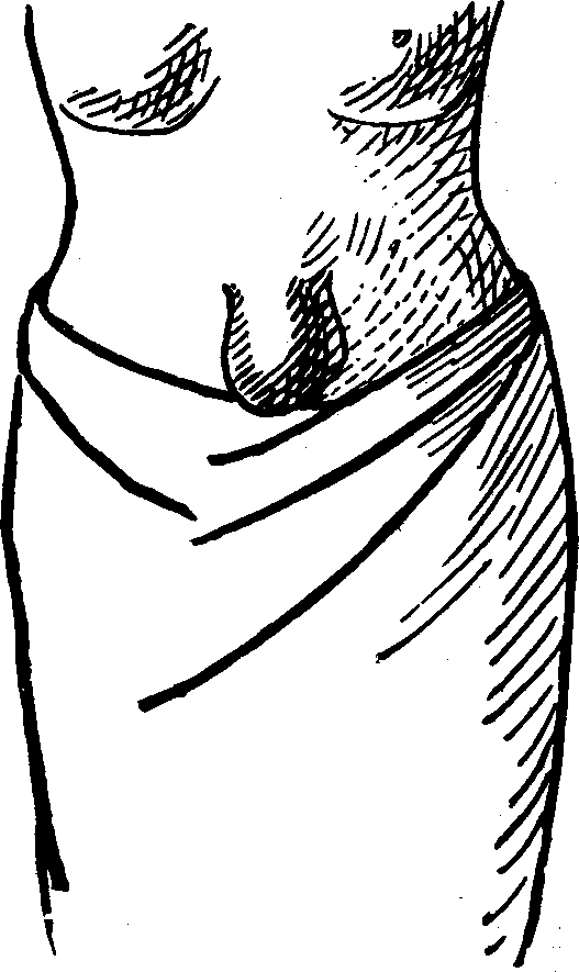 Illustration:
Fig. 3.  UMBILICAL HERNIA.
