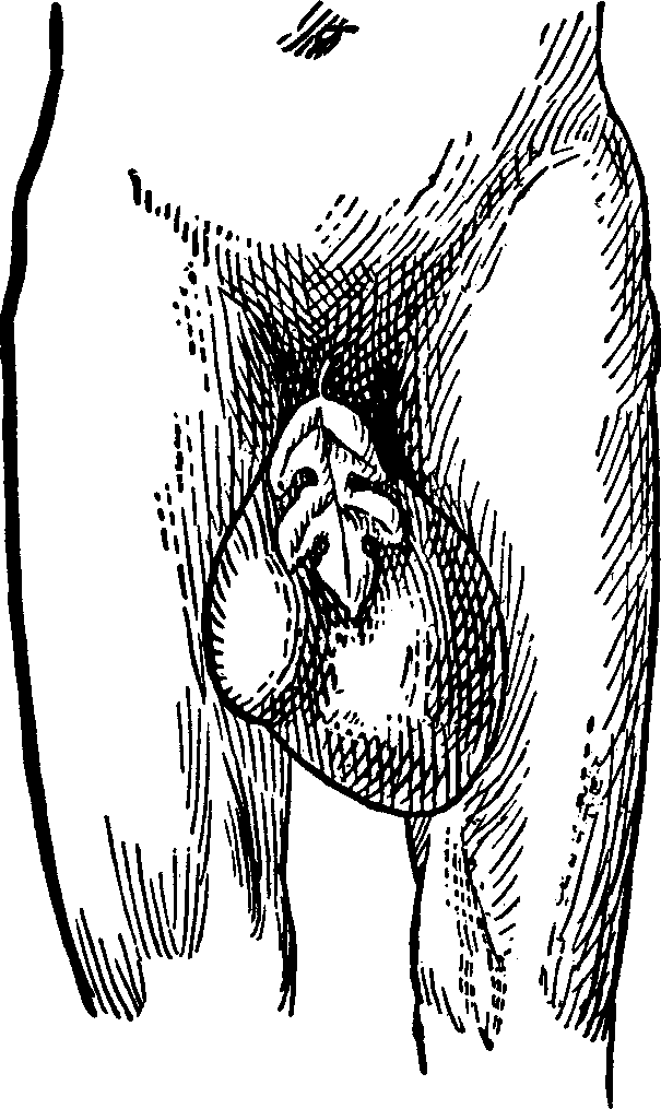 Illustration:
Fig. 4. The above cut fairly illustrates a case of Double Inguinal Hernia,
complicated with Hydrocele, cured at the Invalids' Hotel and Surgical
Institute.