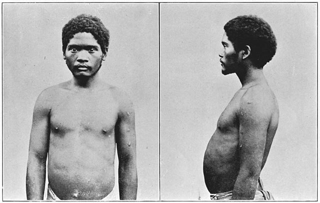 Negrito man of Zambales, mixed blood, showing skin disease.