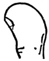 Fig. 1.—THE CLUBBED THUMB.