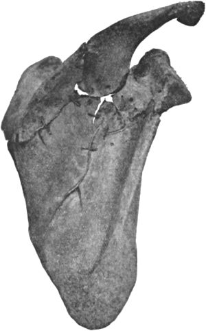 Fig. 26.—Transverse Fracture of Scapula, with fissures
radiating into spinous process and dorsum.