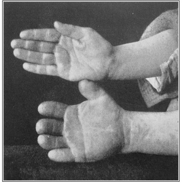 Fig. 32. Normal and brachydactylous hands.