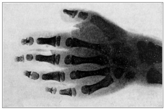 Fig. 33. Radiograph of a brachydactylous hand.