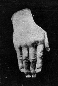 HAND OF JOHN BURNS, M.P.