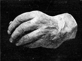 HAND OF JOSEPH ARCH, M.P.
