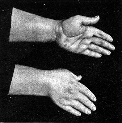 HANDS OF THE TICHBORNE CLAIMANT.