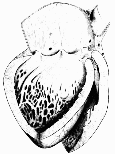 Fig. 7.—Syphilitic aortitis of long standing. The aortic valves are curled and
thickened, the heart is enlarged and the cavity of the left ventricle is dilated. (Milwaukee
County Hospital.)