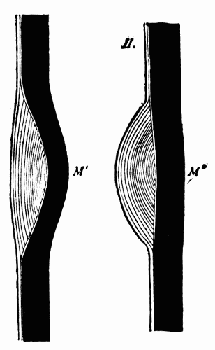 Fig. 8.—I, media weakened at M' with overgrowth of intima filling in the depression.
II, with postmortem rigor and contraction of the muscles of the media and removal
of the blood pressure from within, the stretched media at M'' contracts; the intimal
thickening thus projects into the arterial lumen. (After Adami.)