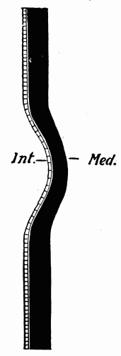 Fig. 9.—Schematic representation of the increased strain brought to bear upon the
cells of the intima, Int., when the media, Med., undergoes a localized expansion through
relative weakness. (After Adami.)