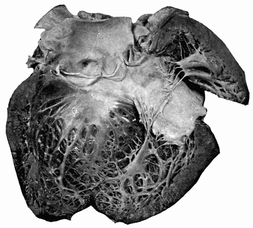 Fig. 12.—Aortic incompetence with hypertrophy and dilatation of left ventricle, the
result of arteriosclerosis affecting the aortic valves. Note how the valves have been curled,
thickened, and shortened, the edges of valves being a half inch below the upper points
of attachment. The anterior coronary artery is shown, the lumen narrowed. (Reduced
one-half.)