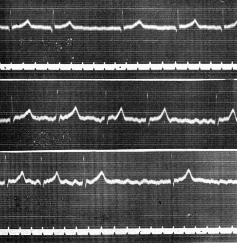 Fig. 41.—Electrocardiogram showing auricular fibrillation in Leads I (upper) and II
(middle and lower). (Courtesy of Dr. G. C. Robinson.)