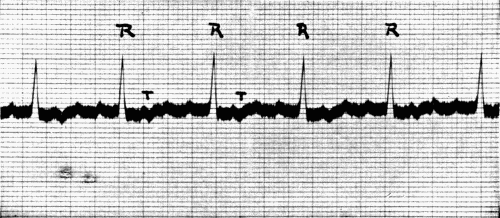 Fig. 42.—Auricular fibrillation. (After Hart.)