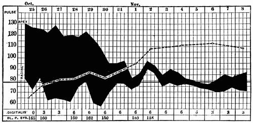 Fig. 43.—The shaded area represents the pulse deficit; the upper edge is the apex
rate, the lower edge the radial rate. The broken line indicates the "average systolic
blood pressure." (Compare these values with the figures at the bottom of the chart,
which show the systolic blood pressure determined by the usual method.) (After Hart.)