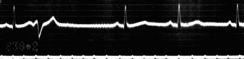 Fig. 46.—Electrocardiogram showing ventricular extrasystole. Heart rate 56-60
beats per minute. Note that diastolic pause in which extrasystole occurs is practically
equal to two normal diastolic pauses. (Courtesy of Dr. G. C. Robinson.)