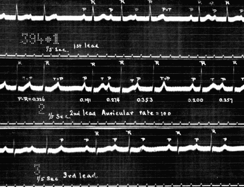 Fig. 48.—Electrocardiogram showing partial heart-block in the three leads. Note
the variability of P-R interval calculated in seconds in Lead II. (Courtesy of Dr.
G. C. Robinson.)