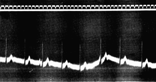 Fig. 51.—Period of auriculoventricular or "nodal" rhythm following exercise in sitting
posture. (After Eyster and Evans.)