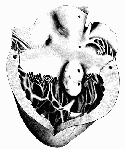 Fig. 59.—Aneurysm of the heart wall. (Milwaukee County Hospital.)