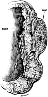 A Section of Primary Cancer of the Fallopian Tube