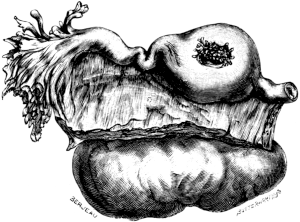 A Gravid Fallopian Tube.