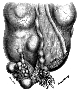 A Fibroid growing near the Right Uterine Cornu