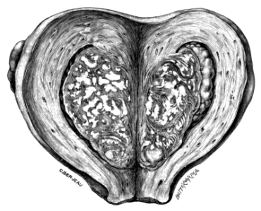 An Adenomyomatous and Tuberculous Uterus