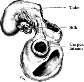 Portion of Ovary and Fallopian Tube.