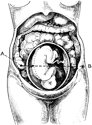Diagram representing a Gunshot Injury of the Uterus
