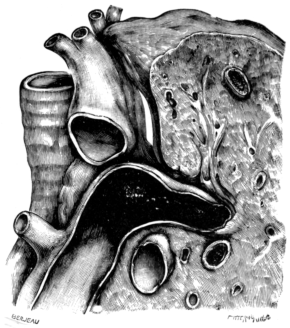 The Pulmonary Artery and Adjacent Part of the Lung and Trachea