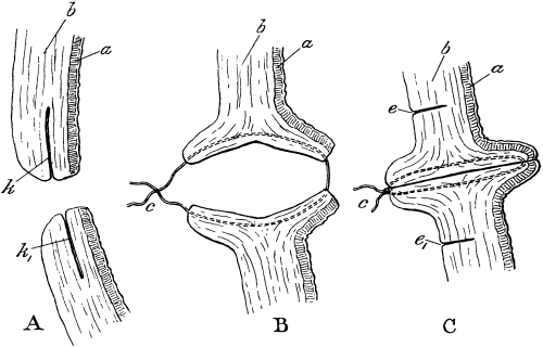 Repair of a Vesico-vaginal Fistula by Dédoublement