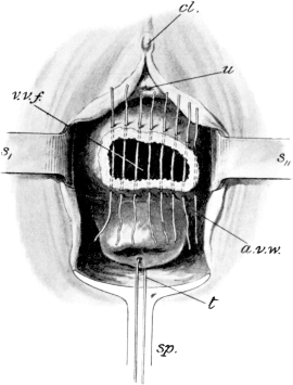 Repair of a Vesico-vaginal Fistula