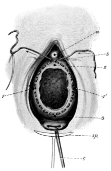 Stoltz’s Operation for Cystocele