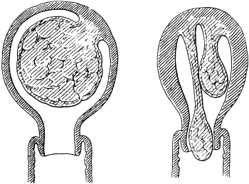 Pedunculated Fibroid Polypi
