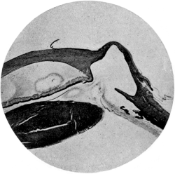Cystoid Scar after Glaucoma Iridectomy