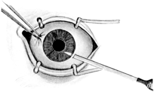 The Knife entering the Anterior Chamber in Cataract Extraction