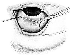 Subconjunctival Extraction