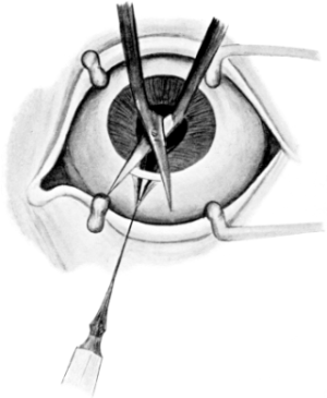 Optical Iridectomy