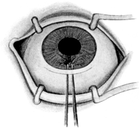 Iridectomy for Glaucoma