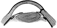 Glaucoma Iridectomy