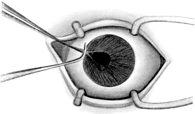 Prolapse of the Iris through a Punctured Wound of the Cornea