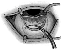 Lagrange Operation
For the Production of a Cystoid Scar in Chronic Glaucoma.